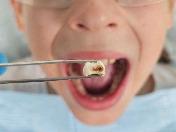 Best Emergency Dental Care for Broken or Chipped Teeth in Catawba, SC