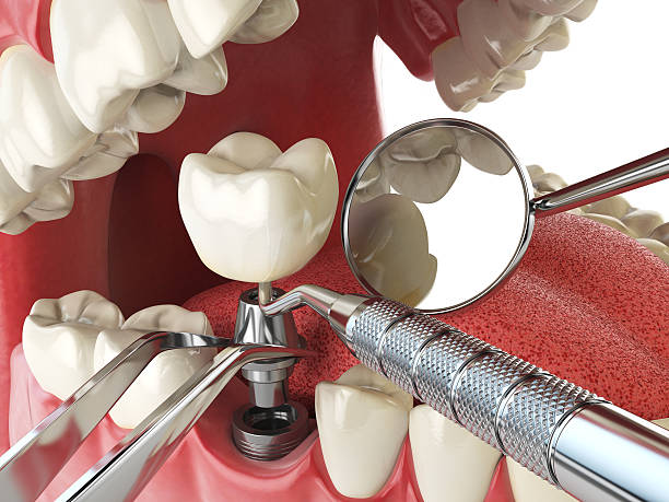 Best Emergency Treatment for Dental Infections or Abscesses in Catawba, SC